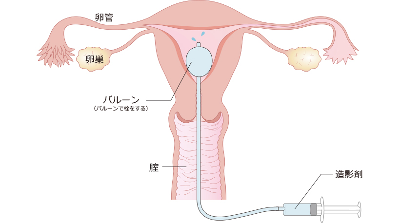 卵管造影検査